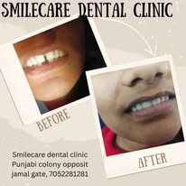 Smile makeover before and after at SmileCare Dental Clinic, Sultanpur