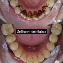 Scaling and polishing before and after at SmileCare Dental Clinic