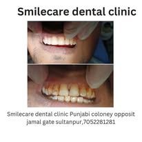Teeth cleaning before and after at SmileCare Dental Clinic